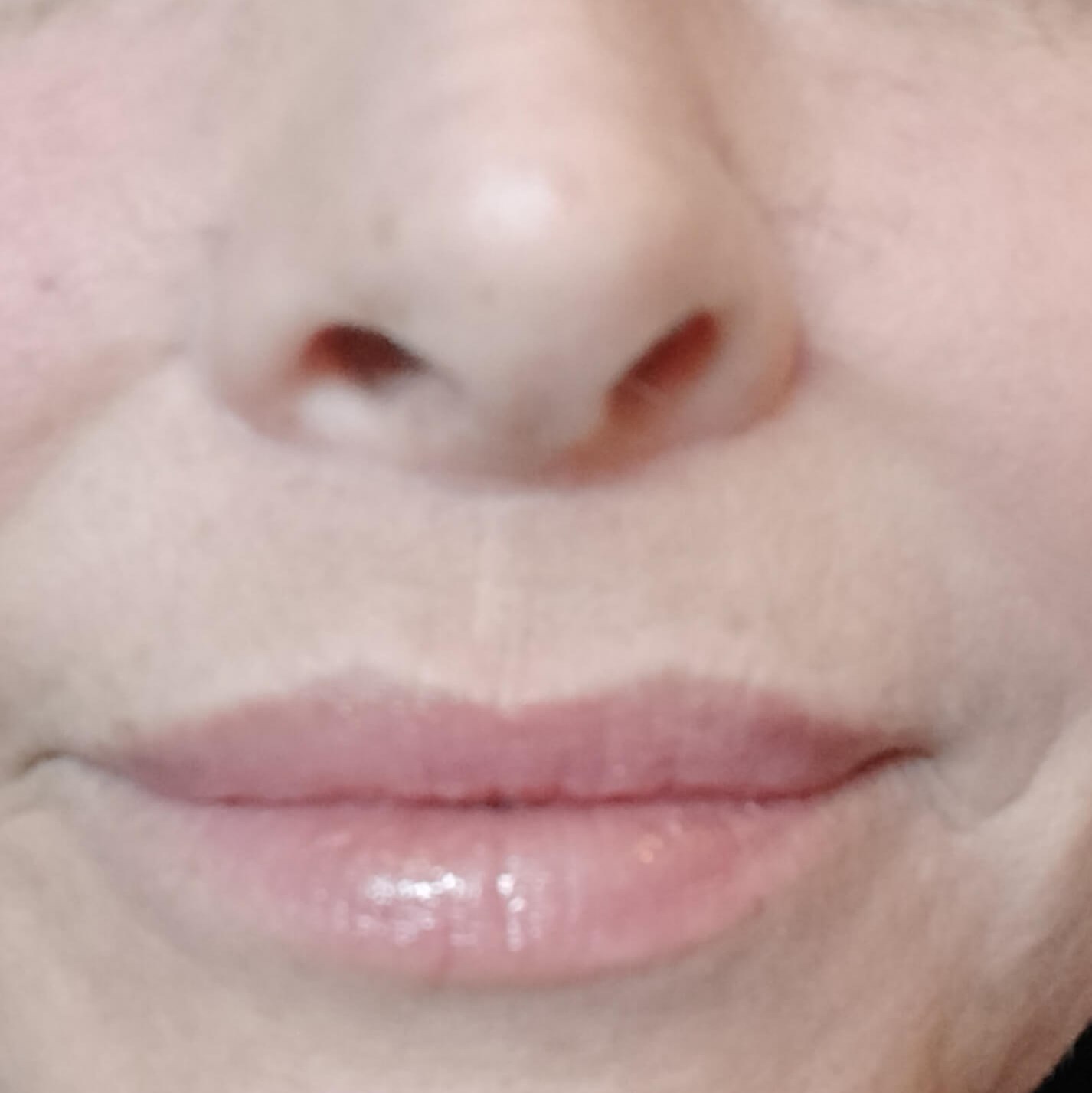 Permanent Lip Flip AFTER